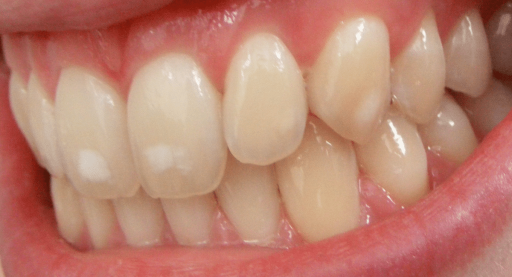 Dental fluorosis mild