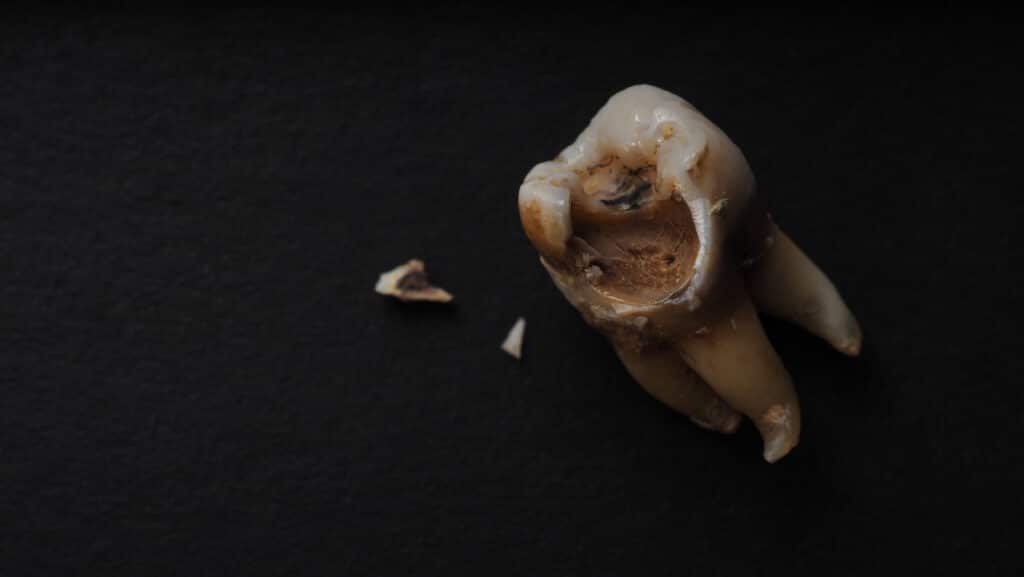 Jak odstranit černé skvrny na zubech? 1 Macro shot of a decayed teeth on black 1346248